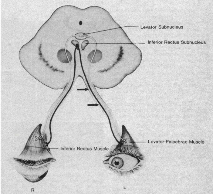 <p>Typically, recovery from CN III paralysis</p>