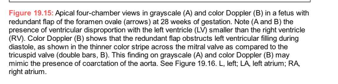 <p>Redundant flap of foremen ovale : ventricular disproportion </p>