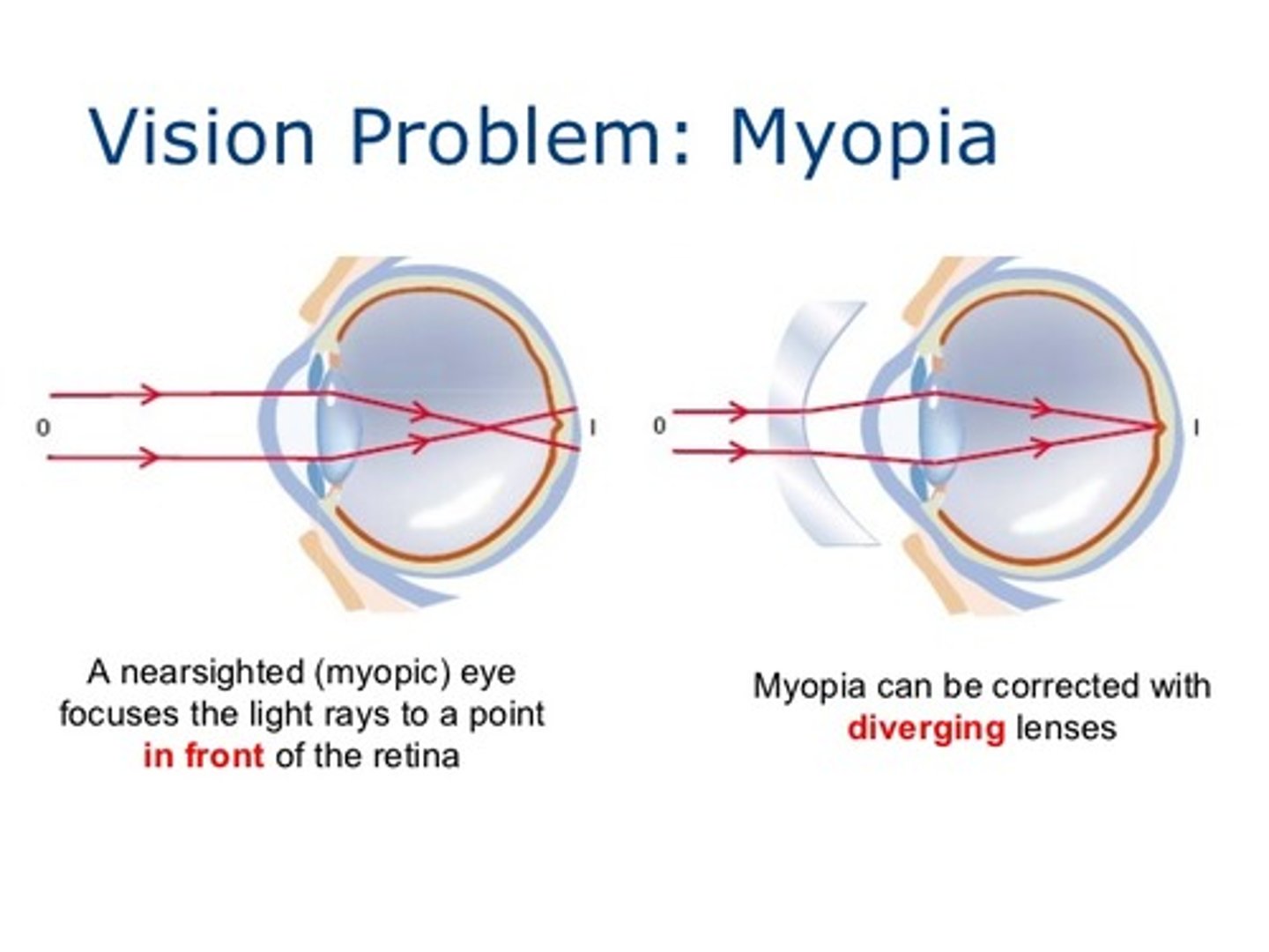 <p>(C) in front of, concave</p><p>A person who is nearsighted will form the image in front of their retina and should be prescribed a concave lens.</p>