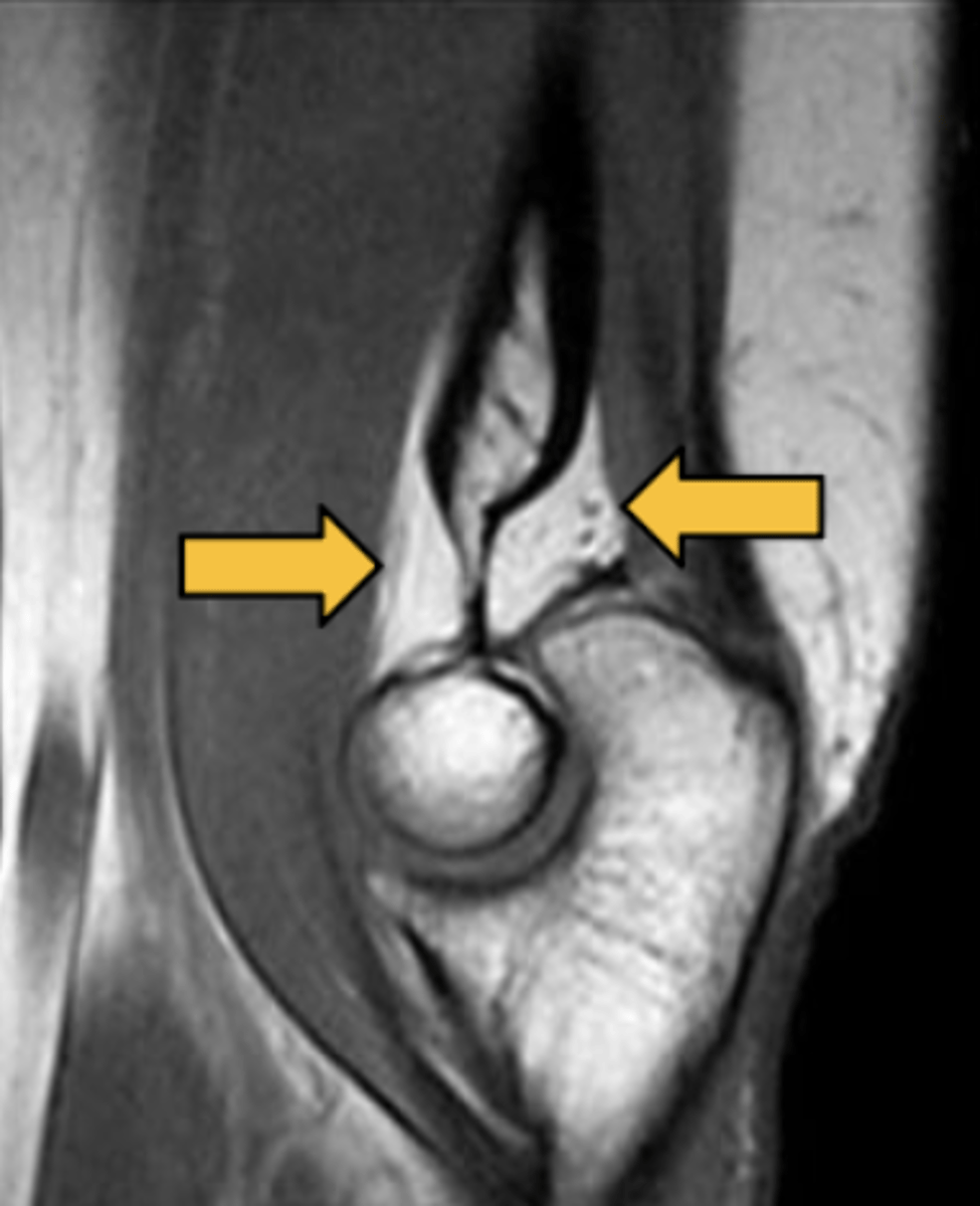 <p>A sagittal MRI image of the elbow shows the coronoid and olecranon fossae, pointed and with fat inside.</p>