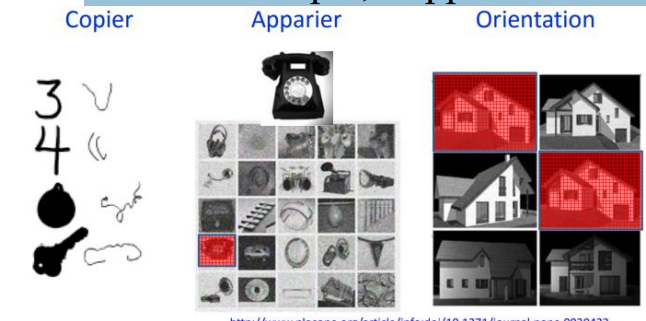 ne pas reconnaitre les stimuli visuels complexes en tant que tels parmi d’autres (objets spécifiques, visages en tant que visages, mot écrit en tant qu’écriture). Il s’agit de la difficulté à identifier la forme générale des entités. Les tâches déficitaires sont la copie, l’appariement et le jugement d’orientation.
Ici, les lésions se situent entre le lobe occipital et le lobe temporal inférieur. Elle est extensive, c’est-à-dire qu’il s’agit d’une grande lésion (3-4cm) et qu’elle est bilatérale.