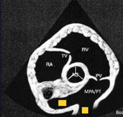 <p>Right Parasternal Short Axis View&nbsp;@ pulmonic valve</p>
