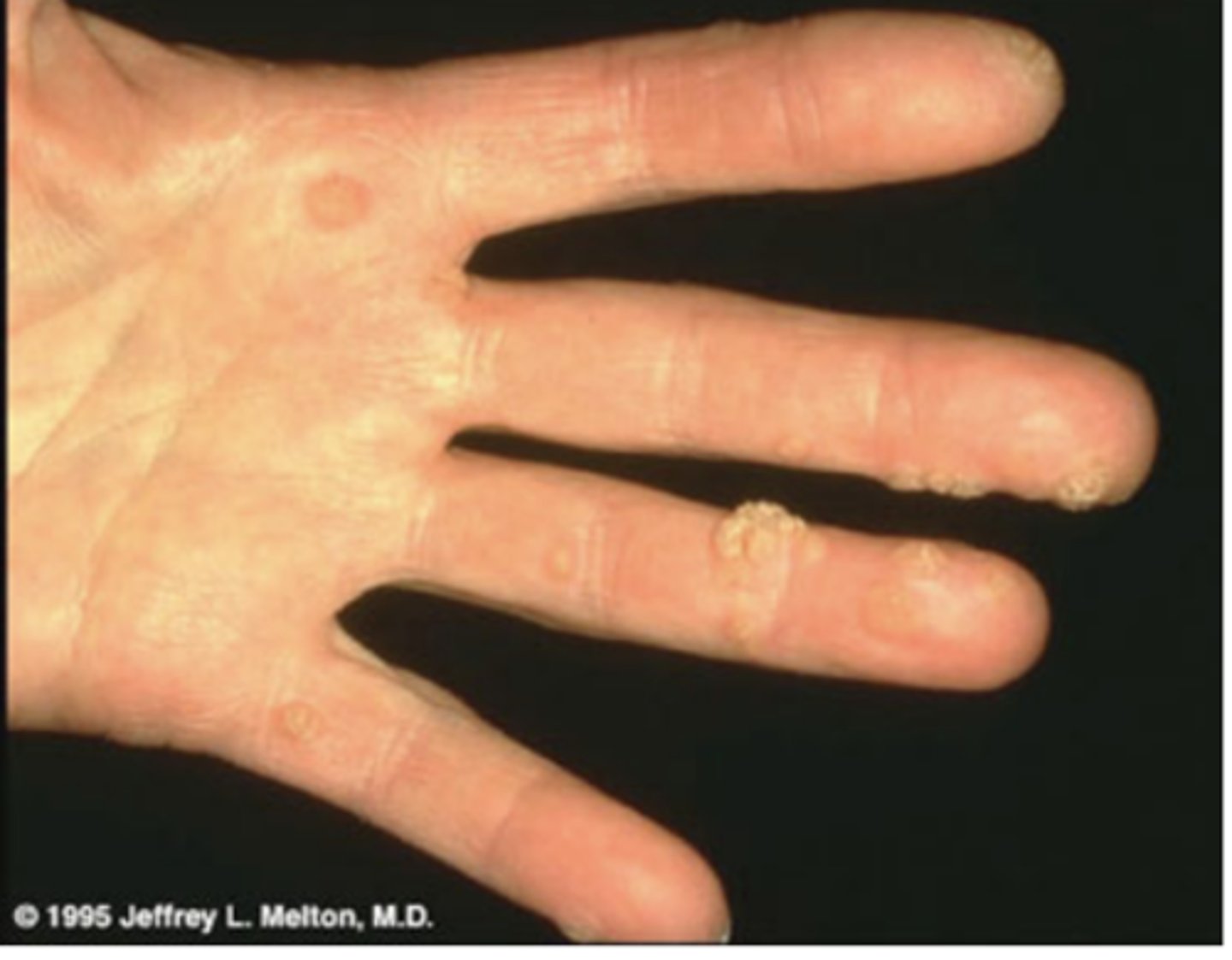 <p>Various morphological types</p><p>Caused by many HPV serotyeps, usually low-risk types</p><p>Long incubation (months)</p><p>Difficult to eliminate (cryotherapy, surgery, acid) and can recur</p>