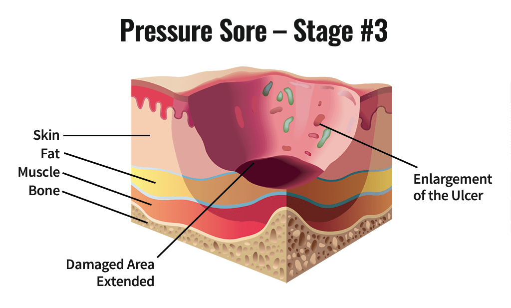 <p>Stage 3 Pressure Injury</p>
