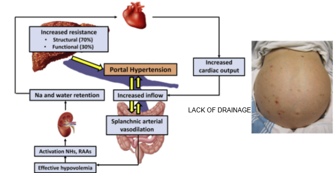 <p>Ascites is the buildup of fluid in the abdominal cavity, often caused by portal hypertension.</p>
