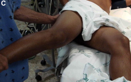 <p><span>is&nbsp;<strong>elicited by having the patient lie on his or her left side while the right thigh is flexed backward</strong>. Pain may indicate an inflamed appendix overlying the psoas muscle.</span></p>