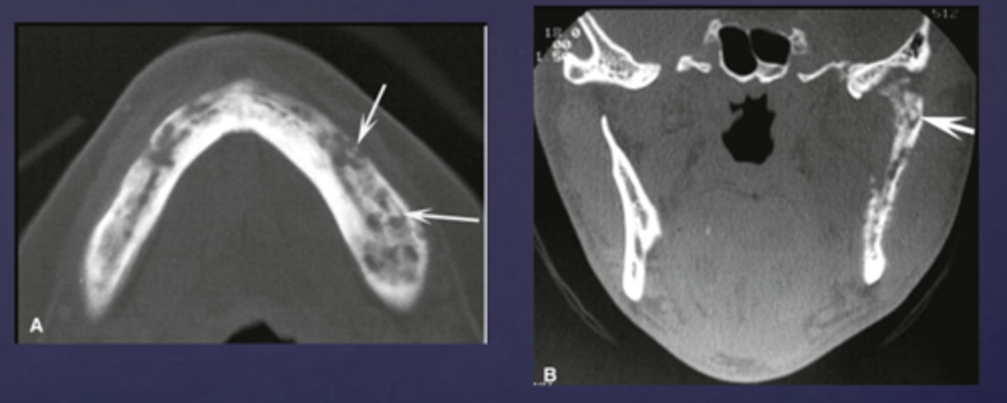 <p>What phase of osteomyelitis does this show?</p>