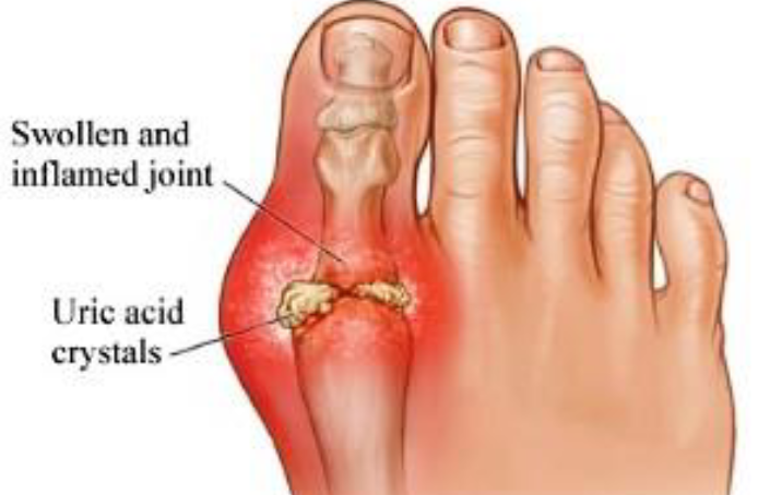 <ul><li><p><span>Deposition of uric acid crystals in joints and soft tissues</span></p></li><li><p><span>More common in men</span></p></li><li><p><span>Typically affects joint at base of great toe</span></p></li><li><p><span>In untreated gouty arthritis, bone ends fuse and immobilize join</span></p></li><li><p><span>Treatment: drugs, plenty of water, avoidance of alcohol and foods high in </span><br><span>purines, such as liver, kidneys, and sardines</span></p></li></ul><p></p>