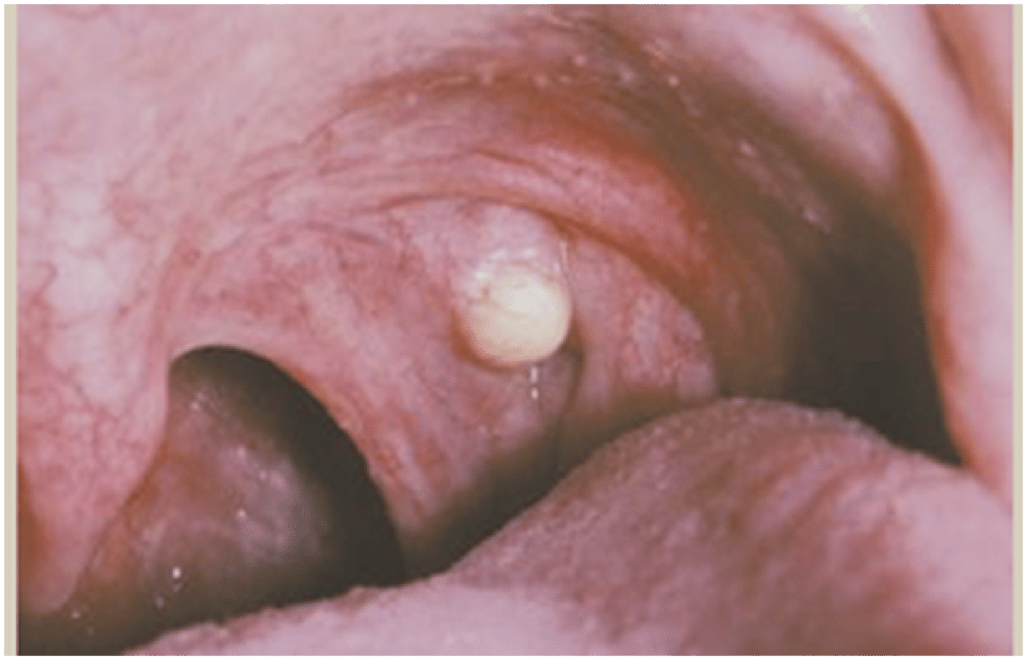 <p>keratin filled cyst</p><p>palatine and lingual tonsils (lymphoid rich)</p><p>excision</p>