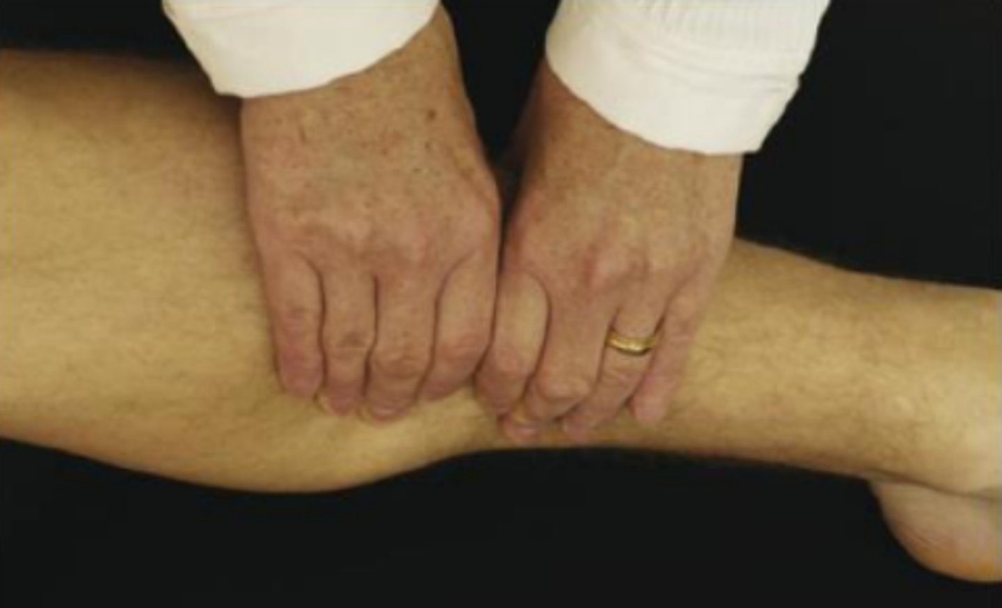 <ul><li><p>syndesmosis integrity</p></li><li><p>(+): pain in lower leg = syndesmosis injury (rule out fracture, contusion, and compartment syndrome)</p></li></ul><ul><li><p><span>A syndesmosis injury of the leg, or "high ankle sprain," is </span><strong><mark data-color="rgba(0, 0, 0, 0)" style="background-color: rgba(0, 0, 0, 0); color: inherit;">damage to the ligaments connecting the tibia and fibula bones just above the ankle joint</mark></strong><span>. Unlike common ankle sprains, it involves tearing the connective tissue, causing high-ankle pain, swelling, and instability, usually resulting from forceful external rotation of a planted foot.</span></p></li></ul><p></p>