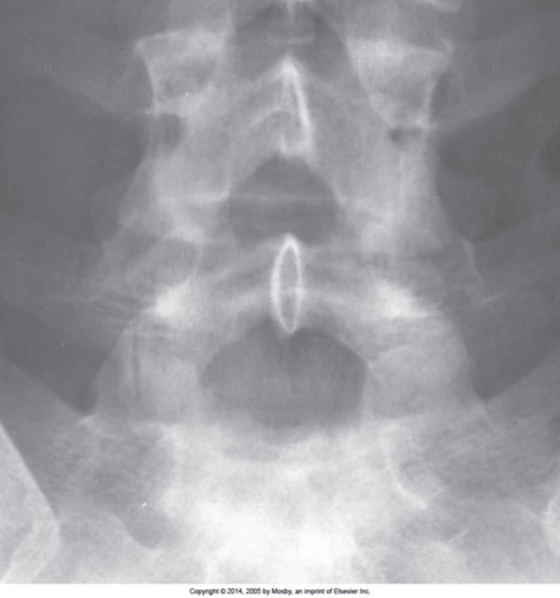<p>S1 superior articular processes are orientated in different planes (one coronal and one sagittal). Normally they should be coronal at the location (rarely at L4/L5)</p>