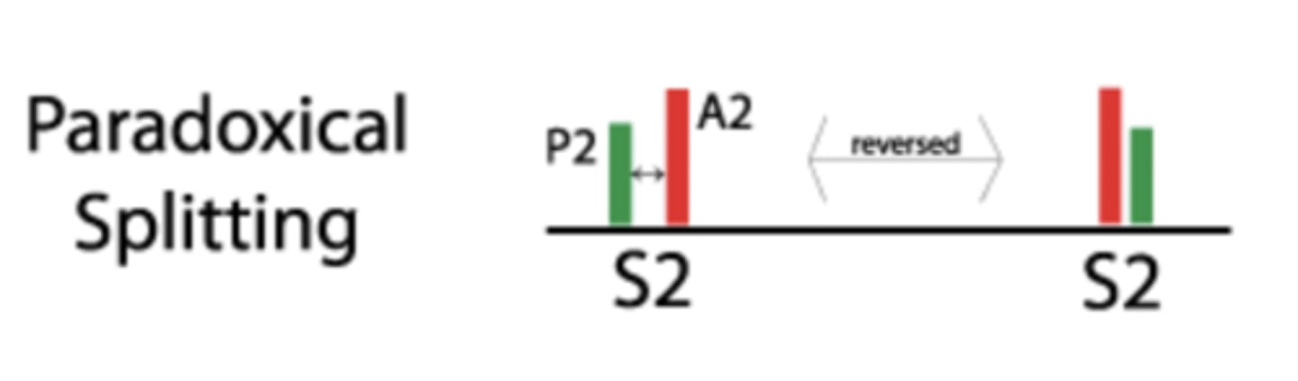 <p>Splitting sound during expiration</p><p>One sound during inspiration</p>