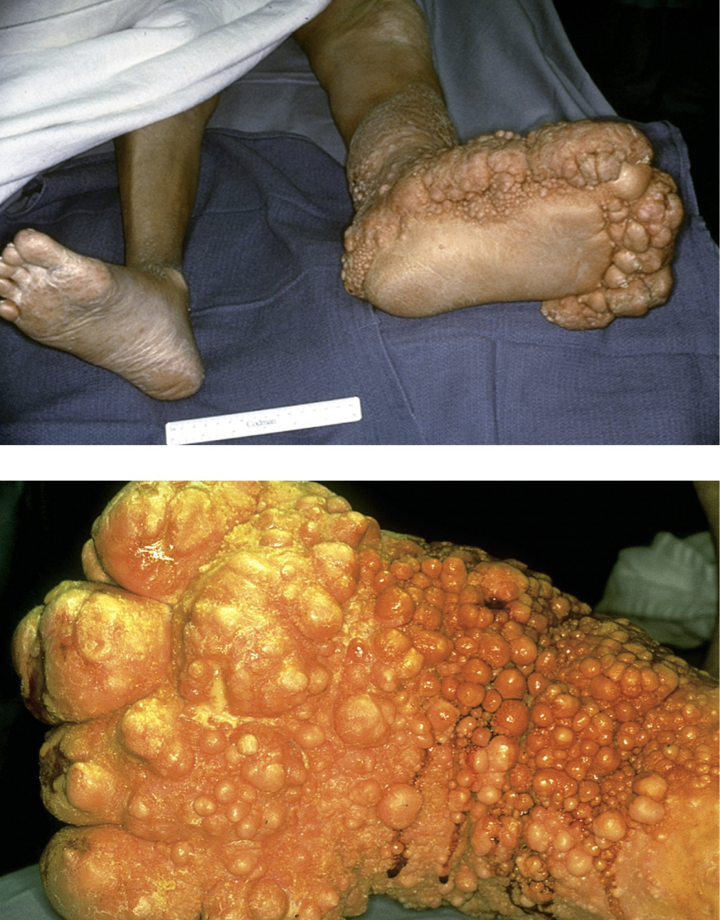 \
Madura foot: fungal skin infection