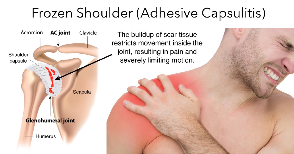 <p>AKA Frozen Shoulder</p><p>- Inflammation and immobility of the glenohumeral ligaments and joint capsule<br>- Causes restrictions in passive range of Motion</p><ul><li><p>Freezing shoulder pain at end ranges</p><ul><li><p>Address pain with ice packs/e-stim, positioning</p></li><li><p>Gentle pain free ROM i.e. reaching to small of back/ behind head</p></li><li><p>HEP with gentle exercises i.e. table glides, functional movements</p></li></ul></li><li><p>Frozen- less pain but loss of motion with capsular patterns (difficulty with external rotation, then abduction, then internal rotation, and then flexion)</p><ul><li><p>Start with hot packs, end with ice</p></li><li><p>AROM + gentle pain free stretching</p></li><li><p>Continue HEP i.e. table glides, functional tasks, cane exercises, wall walking</p></li></ul></li><li><p>Thawing- pain subsides and ROM gradually returns</p><ul><li><p>More stretching</p></li><li><p>Focus on restoring ROM and function</p><p></p></li></ul></li></ul><p>Post-op OT intervention: PROM immediately after surgery, PAMs for pain</p>
