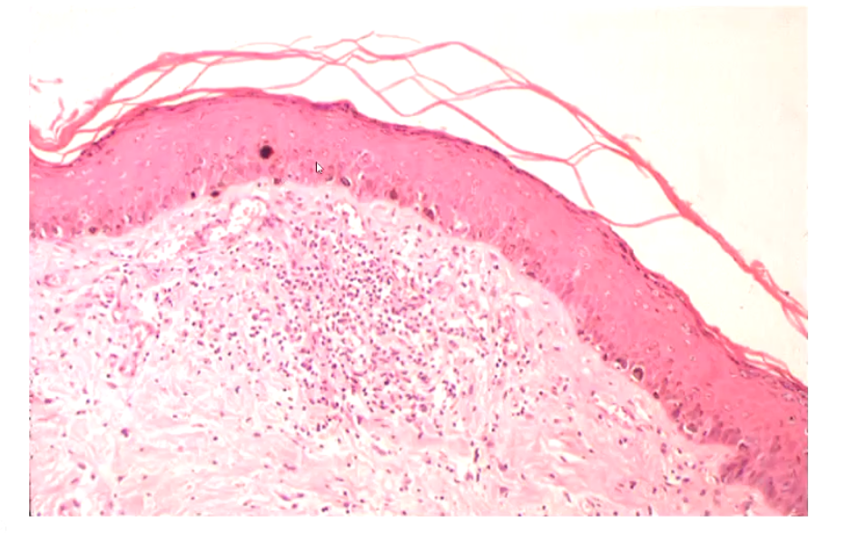<ul><li><p>Hyperplasia / hypertrophy of the spinous layer</p></li></ul><p></p>