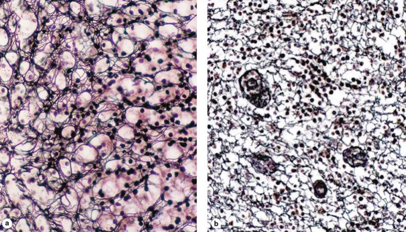 <p><span><span>Found in delicate connective tissue of many organs, notably in the immune system, </span><strong><span>____ ___</span></strong><span>consist mainly of collagen type III, which forms an extensive network (reticulum) of thin (diameter 0.5–2 μm) fibers for the support of many different cells. These fibers serve as a supportive stroma in most lymphoid and hematopoietic organs and many endocrine glands. The fibers consist of type III collagen that is heavily glycosylated, producing the black argyrophilia, an affinity for stains containing silver salts.</span></span></p>