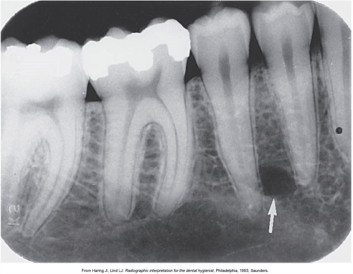<p>Lines inferior to the mandibular apices of bicuspids</p>