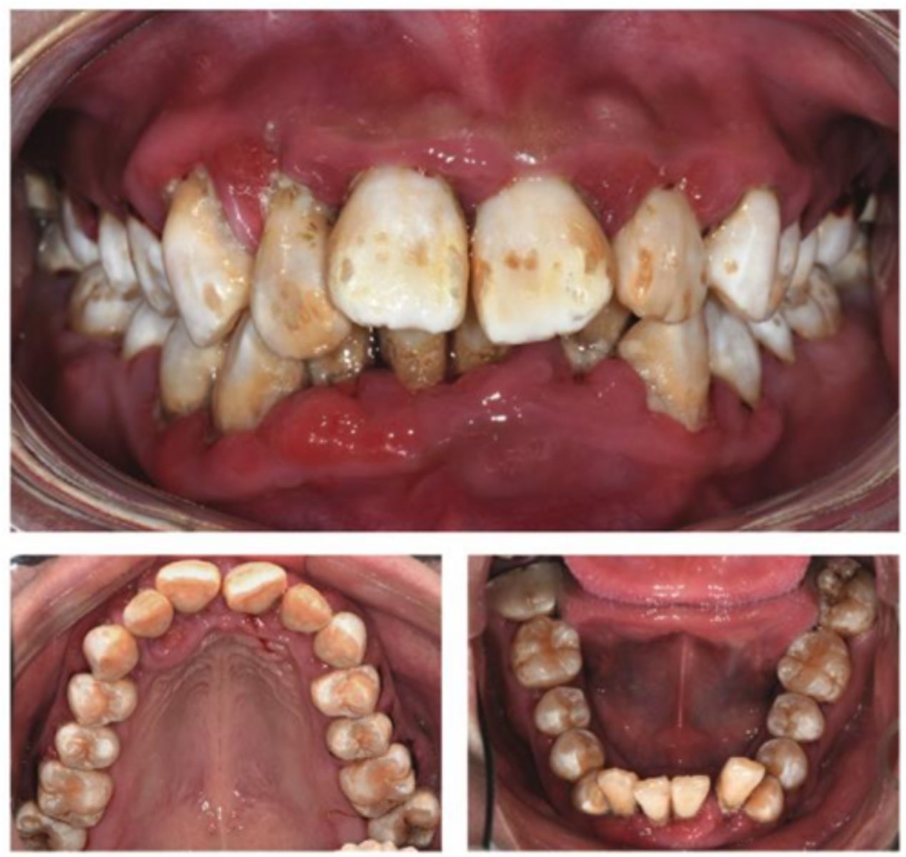 <p>A 21-year-old female was referred to the dental center, complaining of halitosis and swollen and painful gums, which lasted 2 months. The patient has a history of diabetes, which was diagnosed around 11 years ago.</p><p>Following a detailed interview, we gained a thorough understanding of the patient's diabetes……She also had stage 4 renal disease and gout.</p><p>Now, back to our comfort zone…… what are you going to do for the oral examination?</p>