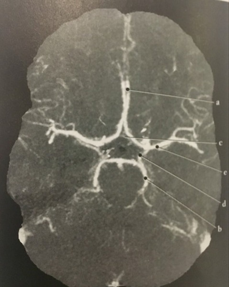 <p>Identify structure B on this axial CTA of the Circle of Willis.</p>