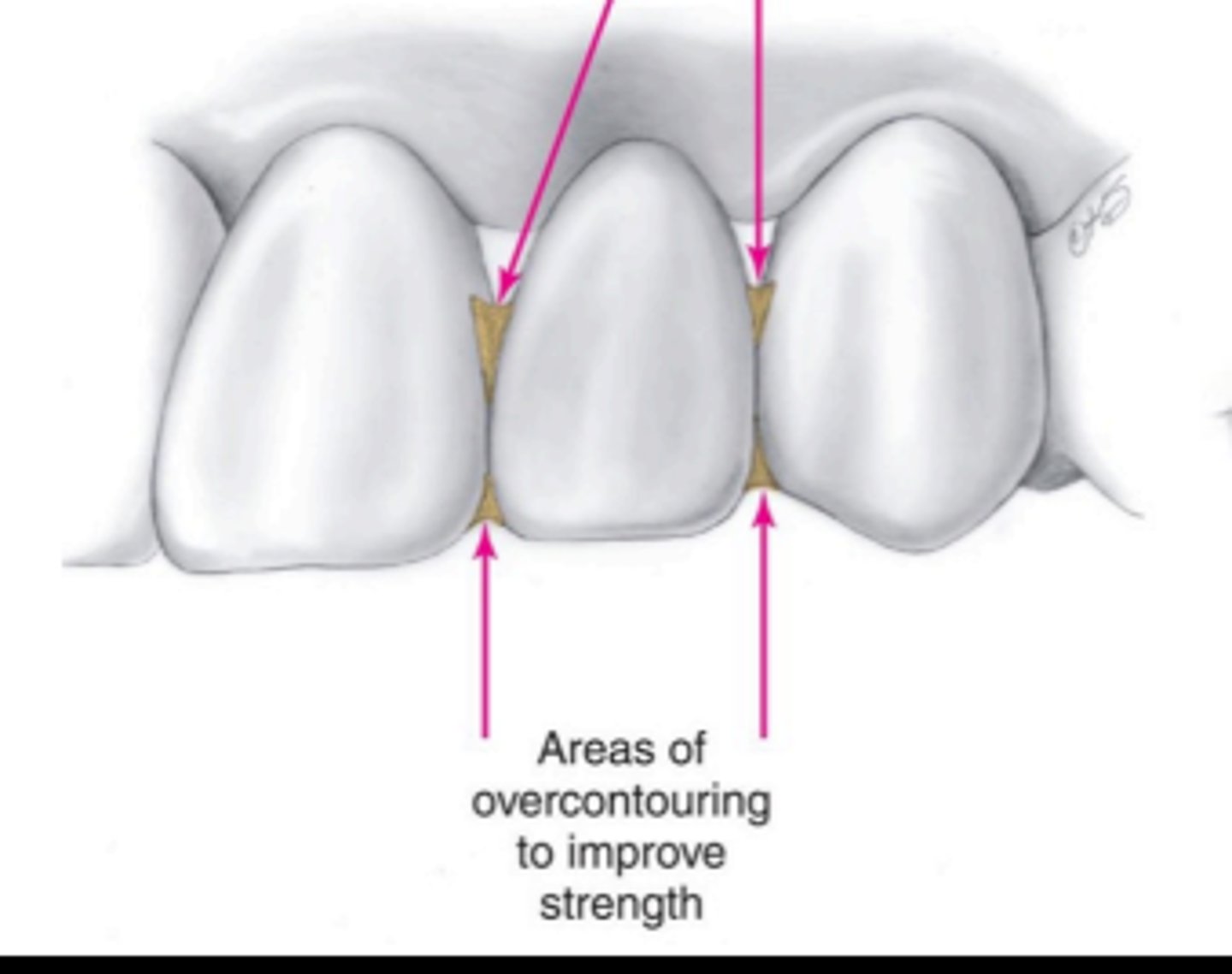 <p>- connector size (overcontouring of interproximal contacts) of provisional restorations is often increased in comparison with the definitive restoration, but not at the expense of cleans ability</p>