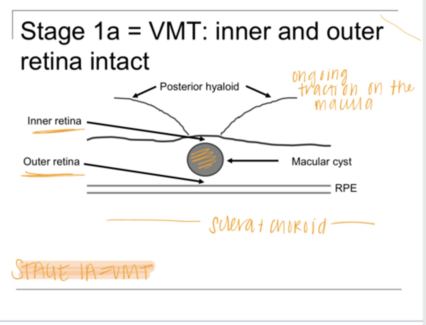 <p>With VMT, there is _____ separation of the retina, Where?</p>
