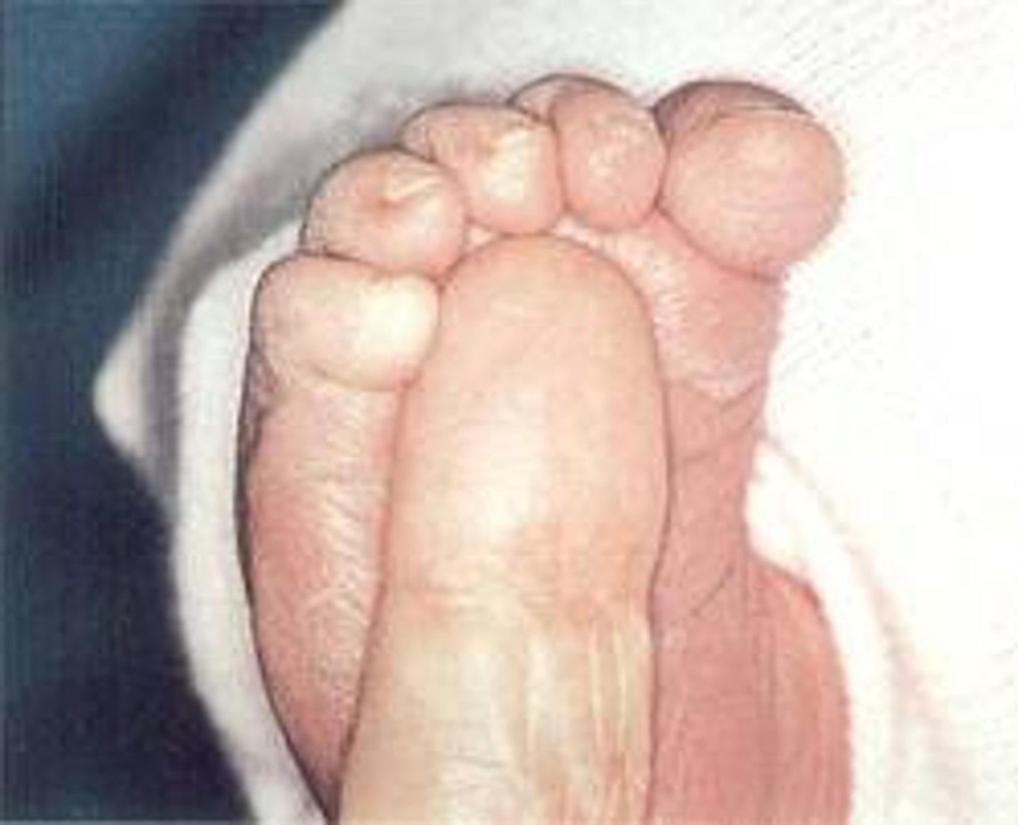 <p>Touch sole of foot, toes curl downwards</p>