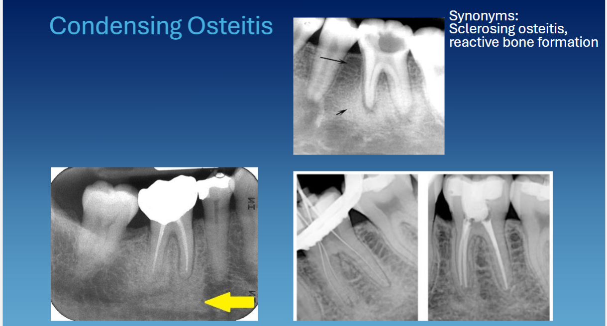 <ul><li><p>periapical to tooth </p></li><li><p>no RL rim </p></li><li><p>widened PDL space </p></li></ul><p></p>