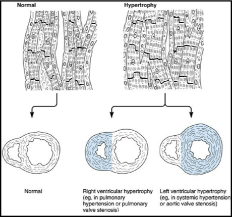 <ul><li><p>hypertension - also left ventricular hypertrophy </p></li></ul><p></p>
