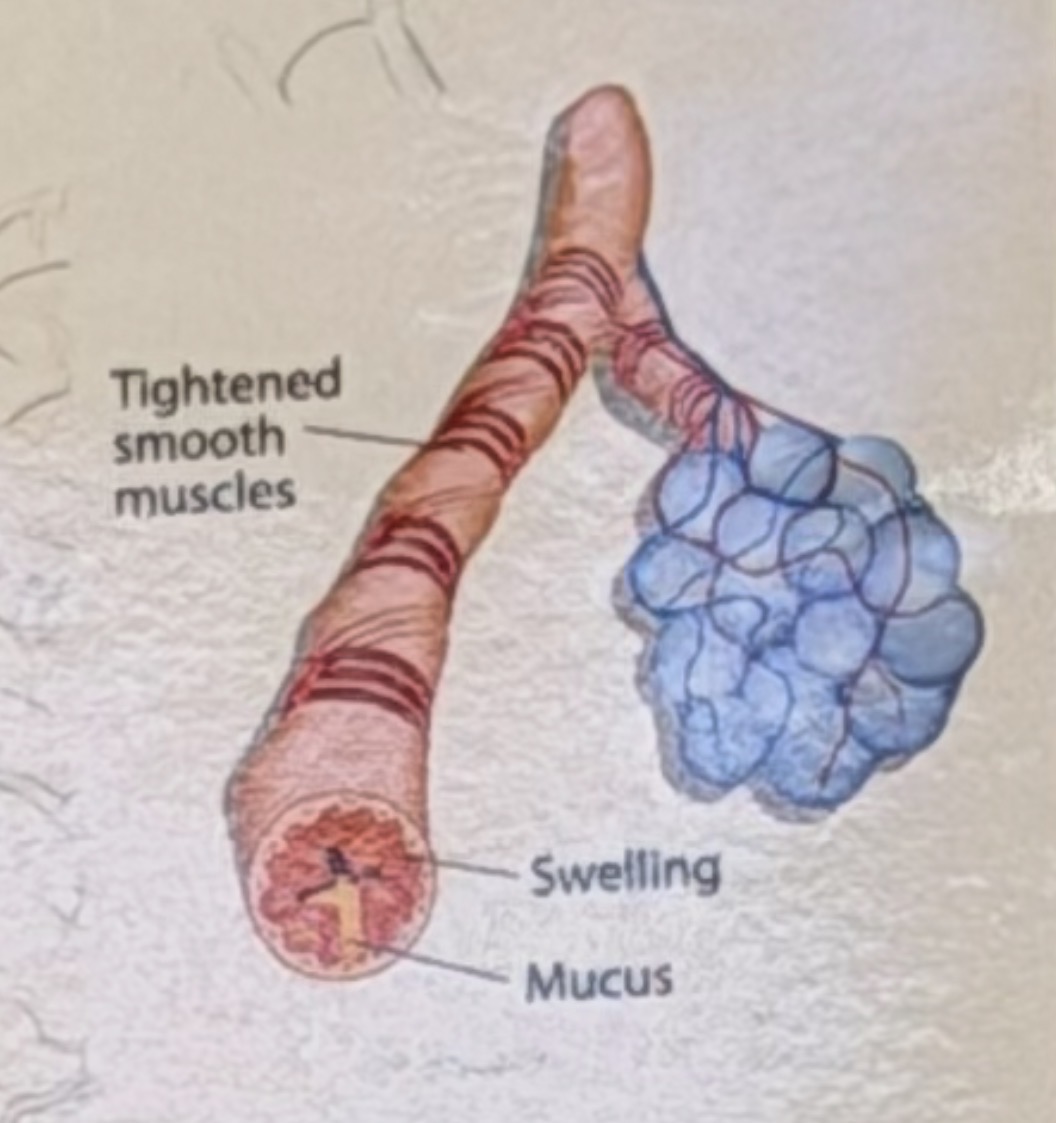 <p>_______ is a chronic lung disease characterized by inflammation and constriction of the airways </p>
