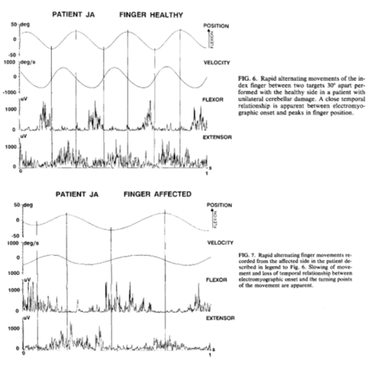 <p>when movement pattern is initiated and when terminated (coordination)</p>