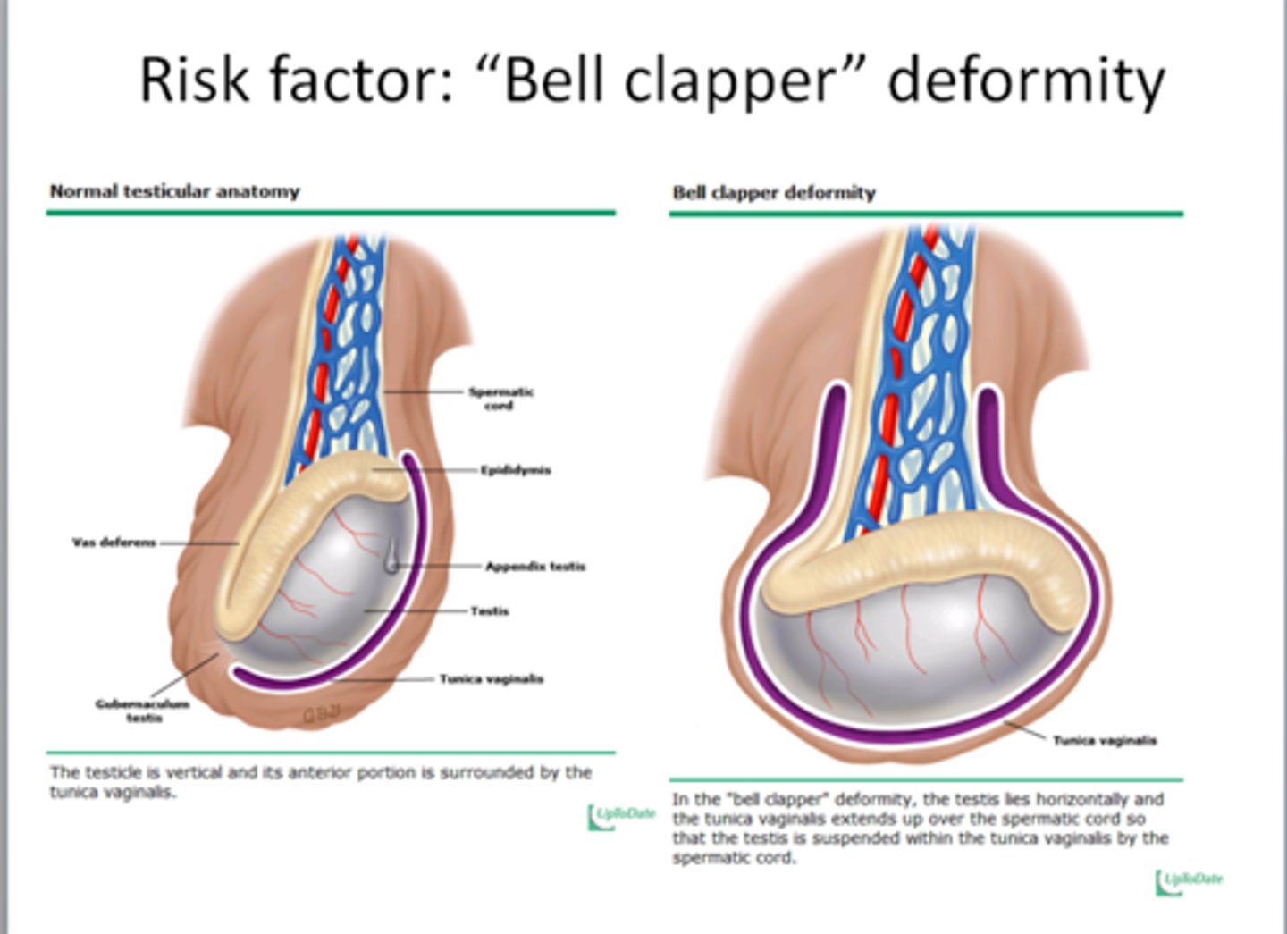 <p>Twisting of spermatic cord, risking testicular necrosis.</p>
