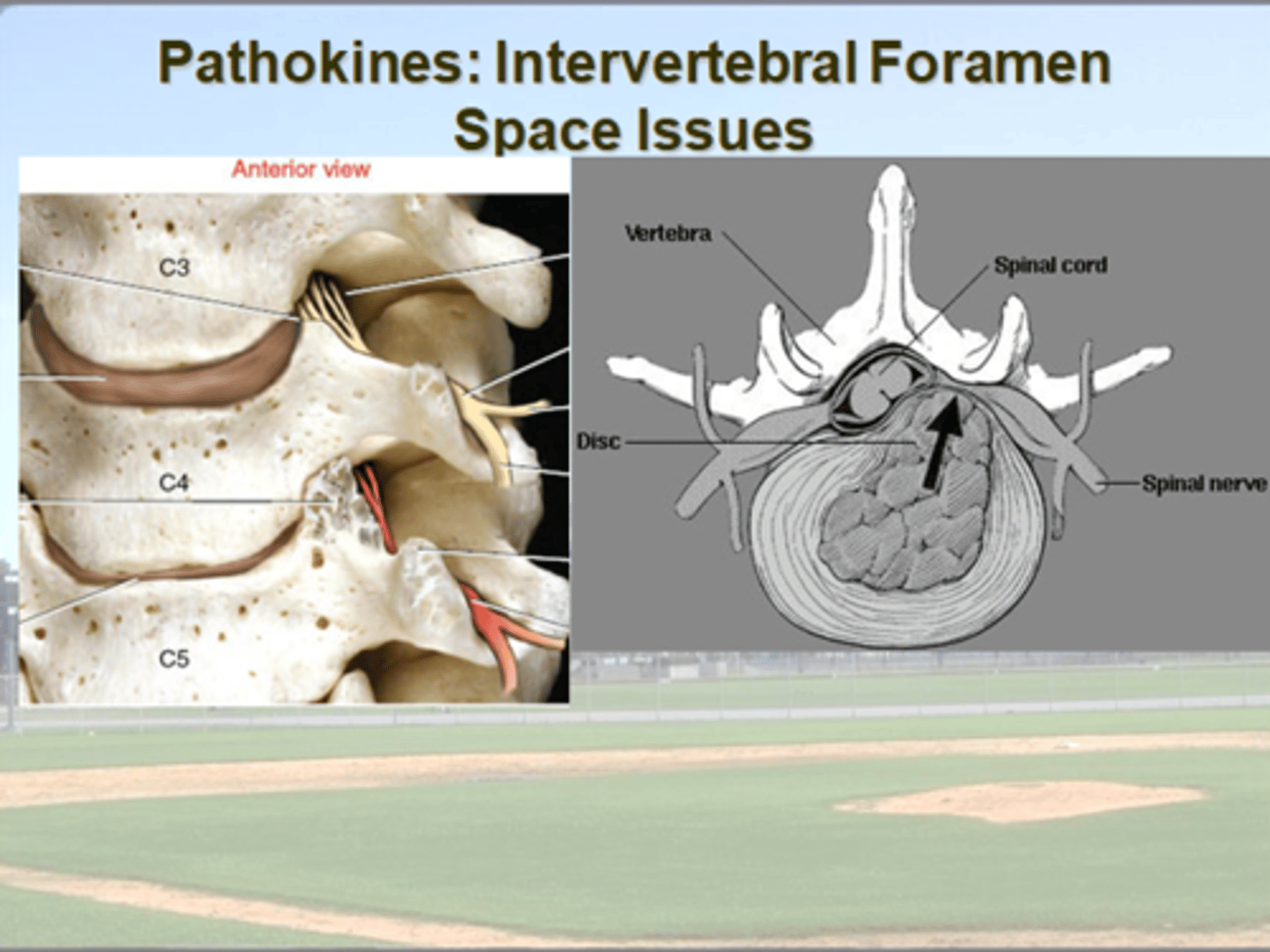 <p>anterior = disk</p><p>posterior = facet joint</p><p>posteromedial</p><p>= ligamentum flavum</p><p>degeneration or dehydration of disc = narrows IV space</p><p>flexion = increases size</p><p>extension = decreases size</p>