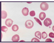 <p><span style="background-color: transparent; font-family: "Times New Roman", serif;">*AR genetic disorder of Hb synthesis</span></p><p><span style="background-color: transparent; font-family: "Times New Roman", serif;">*Hb molecule prone to <strong>molecular aggregation in deoxygenated state</strong> → Hb forms long, inflexible chains → rbcs assume <strong>rigid, curved shape</strong></span></p><p></p><p><span style="background-color: transparent; font-family: "Times New Roman", serif;">*Reduced O2 carrying capacity of sickled rbcs</span></p><p><span style="background-color: transparent; font-family: "Times New Roman", serif;">*<strong>Sickled rbcs aggregate and block capillaries</strong></span></p><p><span style="background-color: transparent; font-family: "Times New Roman", serif;">*One allele affected → 40-50% abnormal Hb, sickling only under certain conditions (low O2)</span></p><p><span style="background-color: transparent; font-family: "Times New Roman", serif;">*Both alleles affected → most abnormal Hb</span></p>