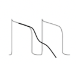 <p>what type of arrhythmia does this action potential result in?</p>