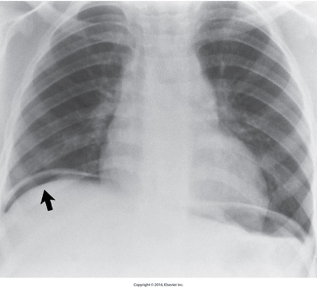 <p>What is Pneumoperitoneum?</p>