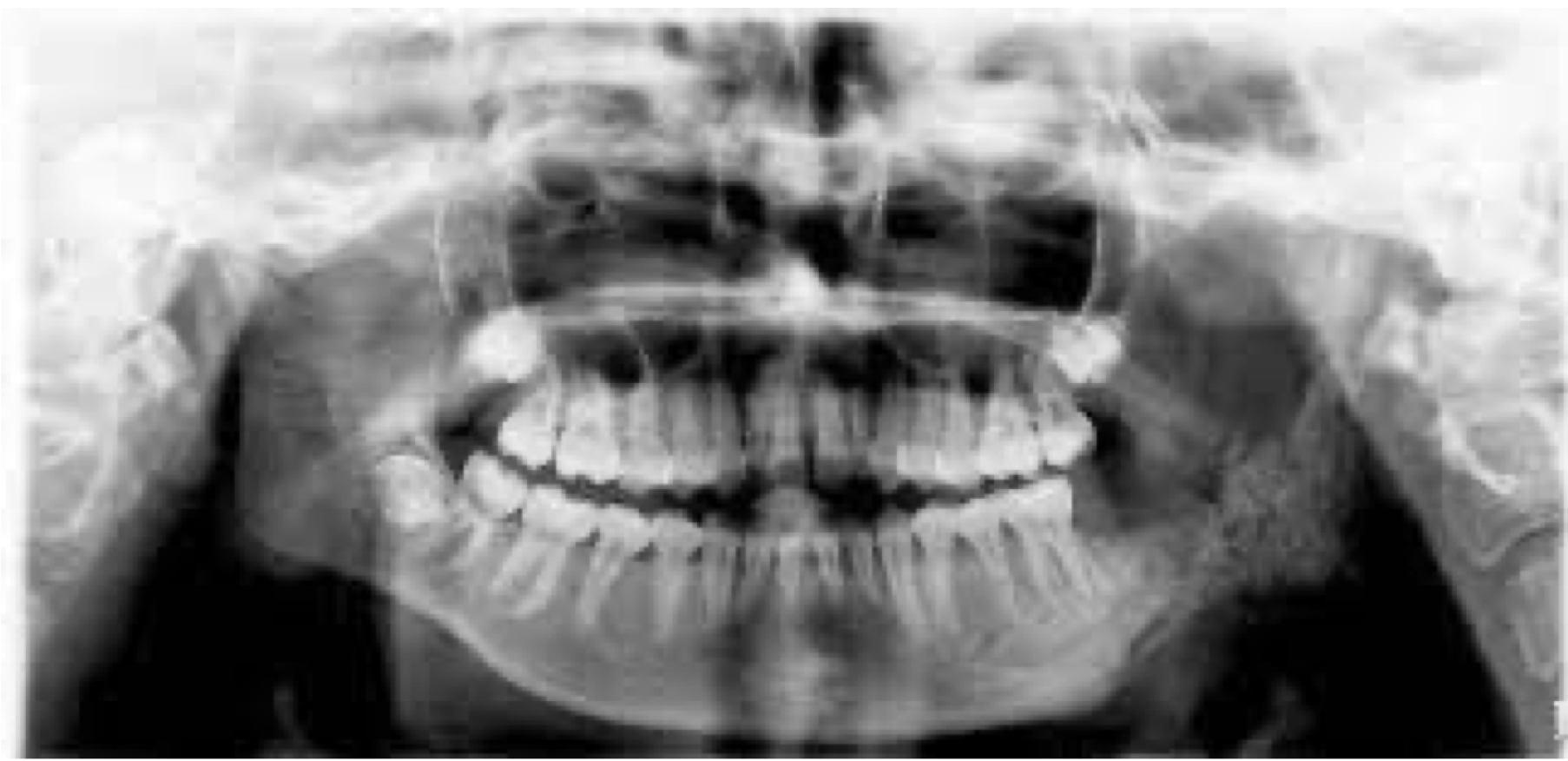 <p>An OPG was taken and provided below. Describe the name of appearance and provide diagnosis</p>