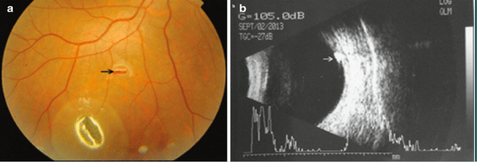 <p>Examine both eyes</p><p>Document the vision bilaterally</p><p>Location (clock notation)</p><p><mark data-color="#NaNNaNNaN" style="color: inherit;">Slit-lamp exam</mark>- anterior segment, fluorescein streaming</p><p>Cornea- edema surrounding the perforation site, opacification, irregular shape</p><p>Scleral entry- conjunctival injection, darker pigmentation in sclera indicated choroid exposure</p>