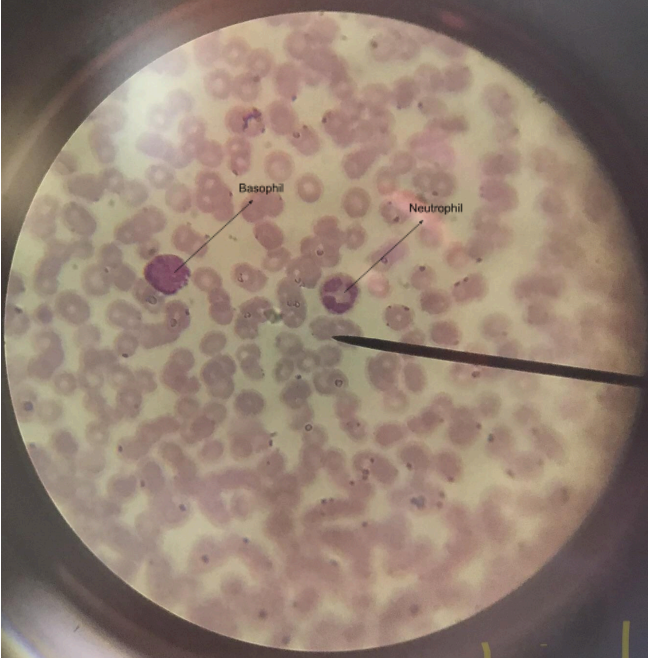 <p>basophils - difficult to find in the human bloodm(0.5-1% of leucocytes), granules of cytoplasm will stain dark blue; nucleus is polymorphic; neutrophils - spherical cells with cytoplasm that is not strongly acidic nor basic in its reaction; cytoplasmic granules will stain light pink/lavender; nucleus is elongated; phagocytes (kill bacteria)</p>