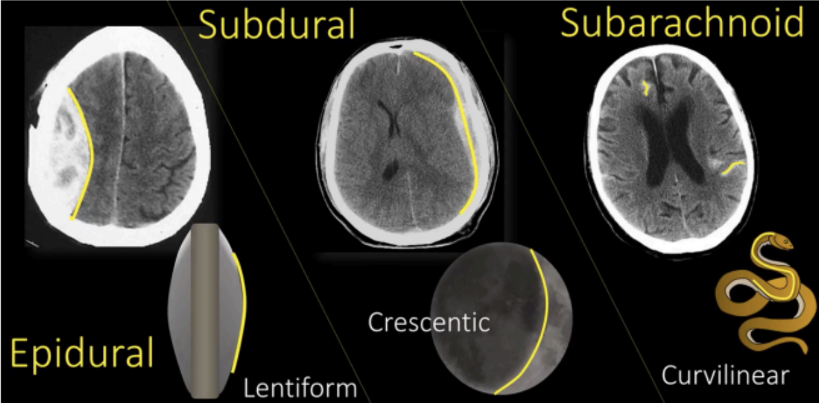 <p>Subdural hemorrhage</p>