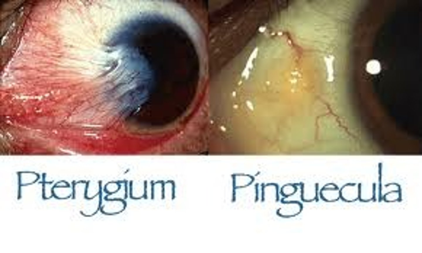 <p>A. Pterygium</p><p>* A pinguecula is characterized by a yellowish raised growth on the conjunctiva typically at the nasal or temporal conjunctiva near the edge of cornea</p><p>* Pterygium is the triangular shape of vascularized conjunctival tissue on the cornea and it invades the cornea (known as fibrovascular invasion of the cornea)</p>