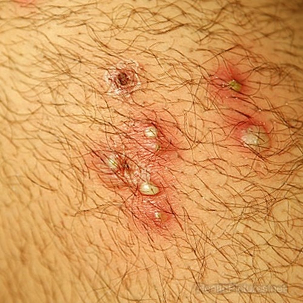 <p>PE:</p><p>Multiple small, erythematous "follicular" papules and pustules scattered in areas of hair growth</p>