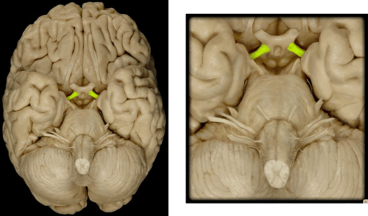 <p>How information from the optic nerve travels to the thalamus.</p><p>mixed fibers medially and laterally</p>