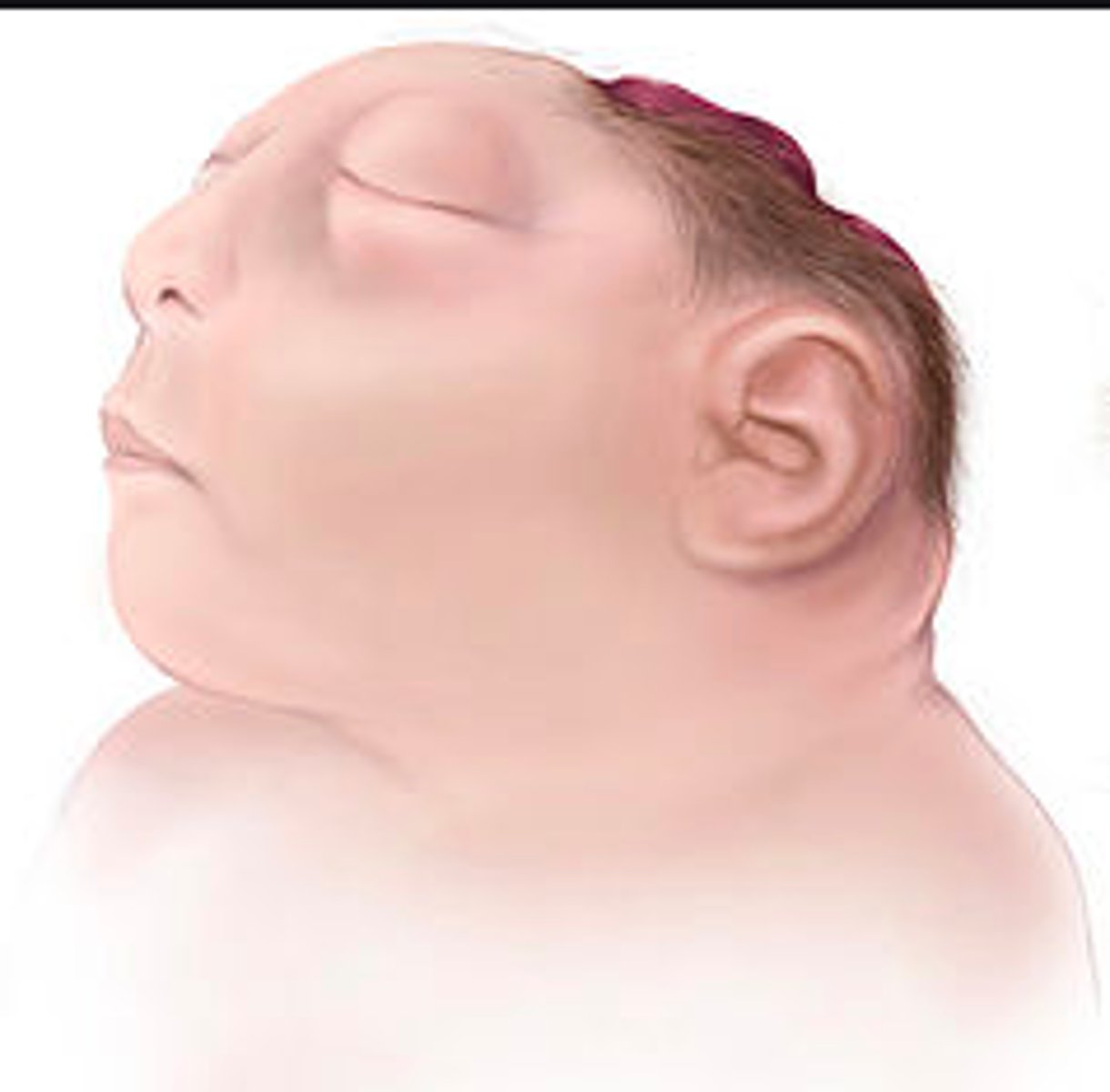 <p>A condition where there is no cranium or brain tissue.</p>