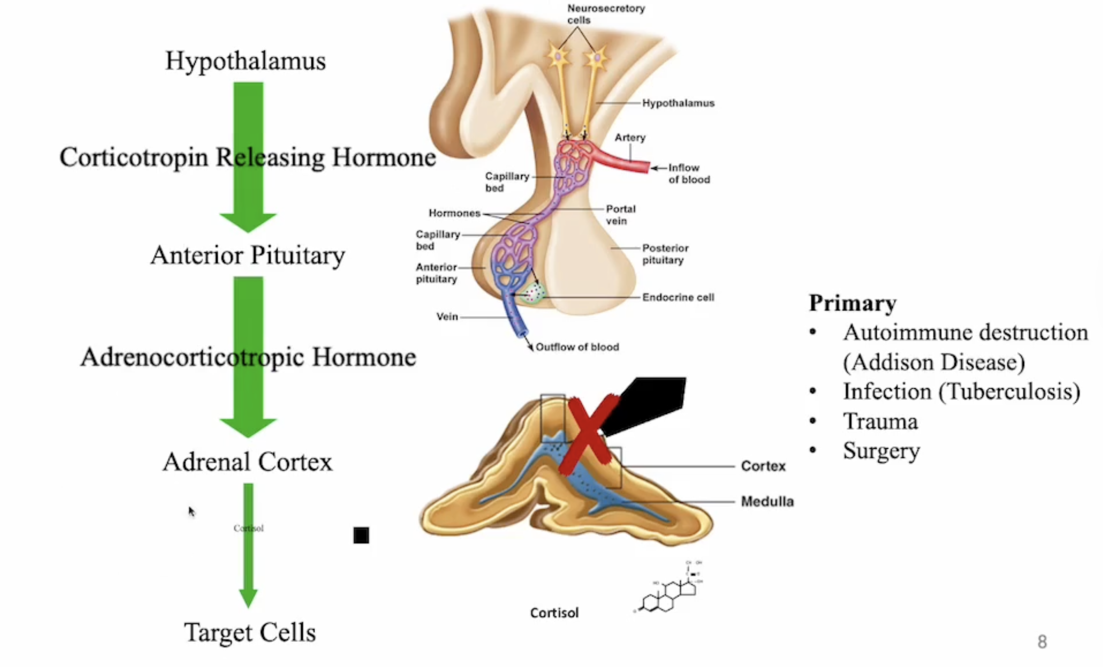 <p>destruction or dysfunction of adrenal cortex (Addison’s disease, infection e.g. tuberculosis, trauma, surgery)</p><p>usually caused by autoimmune dysfunction </p><p>more common in women</p><p>results in deficiencies in cortisol, aldosterone, androgens</p>