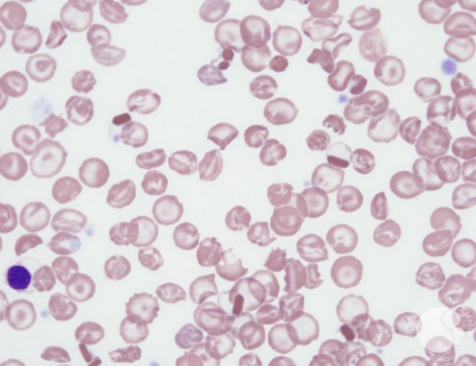 <p>what disease/condition is associated with increased codocytes and Hb C crystals?</p>