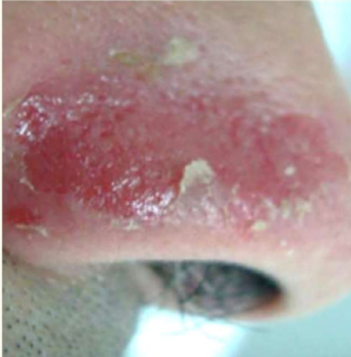 <p>¿lesión?</p><p>¿primaria o secundaria?</p>