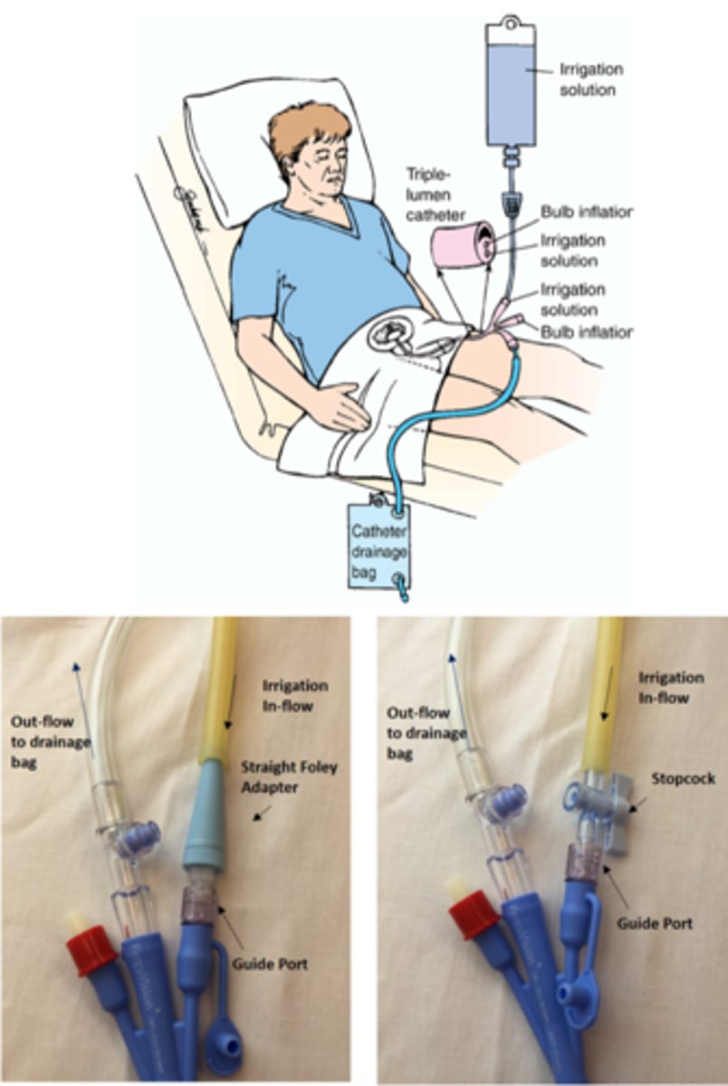 <p>it is prescribed after TURP to prevent obstruction of urine outflow by removing clotted blood from the bladder</p>