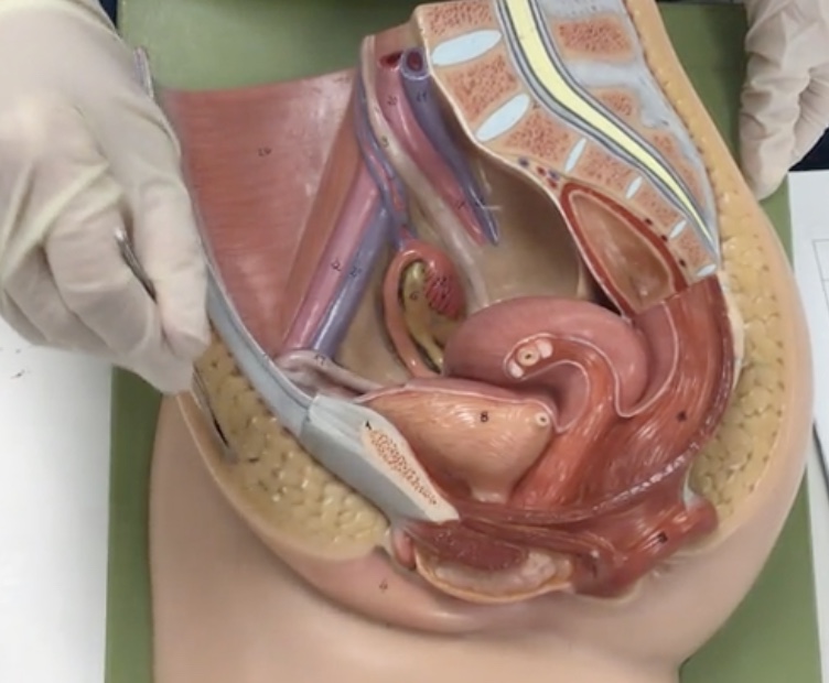 <p>Description: Subcutaneous fat pad anterior to pubic symphysis</p><p>Relationship: After puberty, is covered in hair</p>