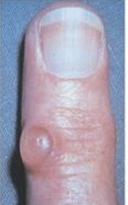 <p>1CM OR LARGER, ELEVATED, ENCAPSULATED, FLUID-FILLED OR SEMISOLID MASS ARISING FROM THESUBCUTANEOUS TISSUE</p>