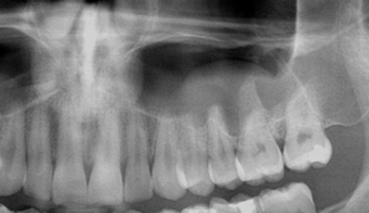 <p>What is the diagnosis?</p><p>- Not a true cyst</p><p>- Obstruction or dilatation of the duct of sero-mucous glands in sinus resulting in submucosal accumulation of secretions</p><p>- Radiographic feature :</p><p>- Relative radiopacity on the floor of sinus</p><p>- Well-defined, not corticated</p><p>- Dome-shaped</p>